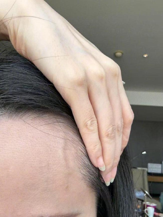 营养不良风湿性免疫力低下OG真人张靓颖自曝体检(图2)